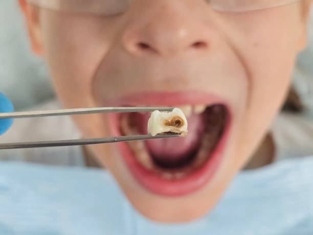 Best Emergency Dentist for Lost Fillings or Crowns in Millsboro, DE